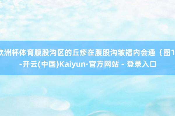 欧洲杯体育腹股沟区的丘疹在腹股沟皱褶内会通（图1）-开云(中国)Kaiyun·官方网站 - 登录入口